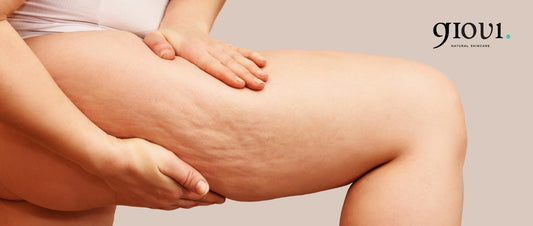 QUALI SONO GLI STADI DELLA CELLULITE? IMPARIAMO A RICONOSCERLI